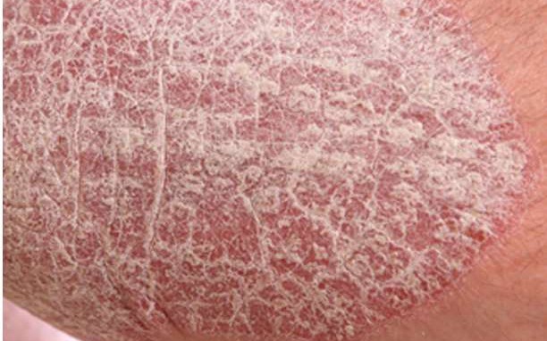 Ψώρα στο δέρμα: Συμπτώματα και θεραπεία