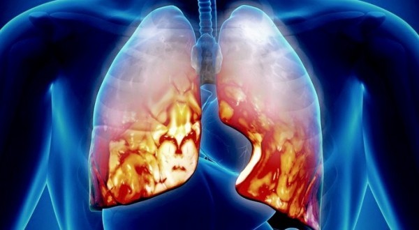 Πνευμονία: Μήπως δεν έχω απλό κρυολόγημα;