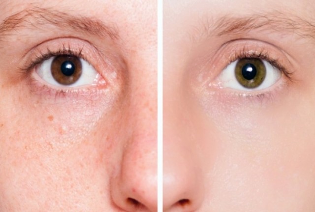 Λιπαρότητα και ακμή- Τι πρέπει να προσέχετε