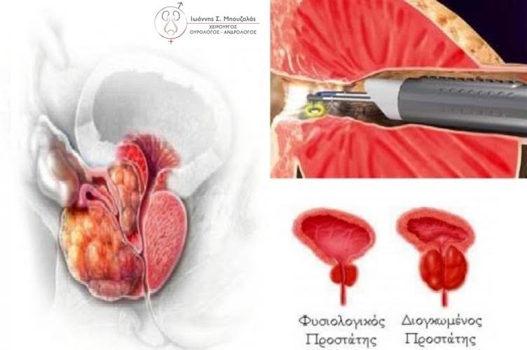 Το μέγεθος του προστάτη αυξάνει και η ποιότητα της ζωής του άνδρα μειώνεται