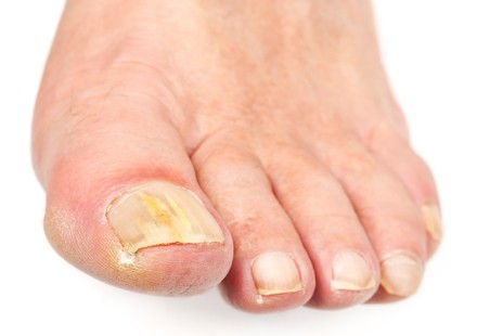 Μυκητίαση ποδιών: Πώς προκαλείται και πώς θεραπεύεται