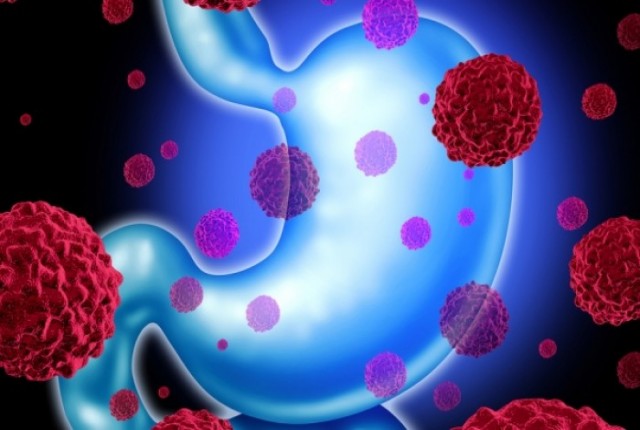 Καρκίνος στομάχου: Ποια είναι τα ύποπτα σημάδια, πώς θα μειώσετε τον κίνδυνο