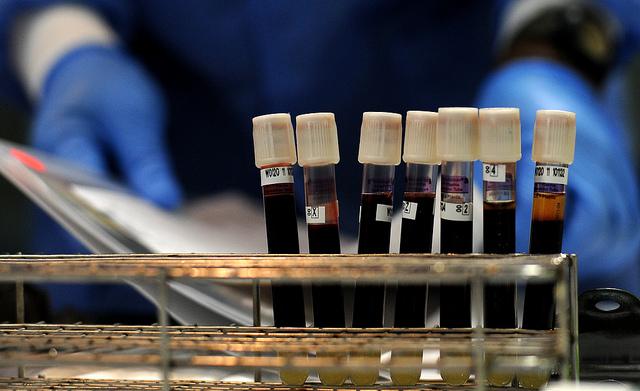 Από ποιες ασθένειες κινδυνεύετε ανάλογα με την ομάδα αίματός σας