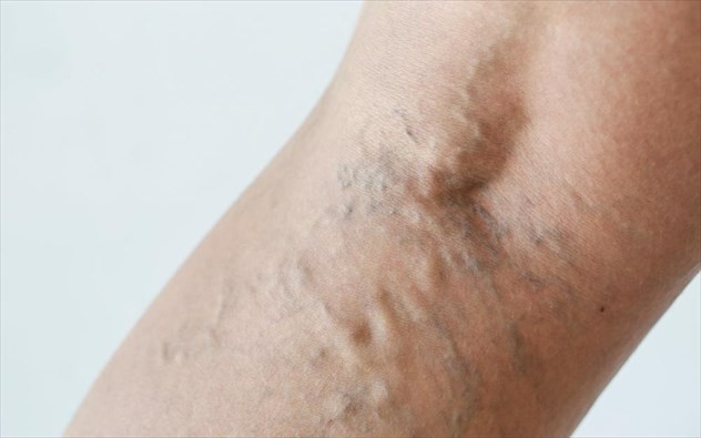 Γιατί να χειρουργήσω τους κιρσούς μου;