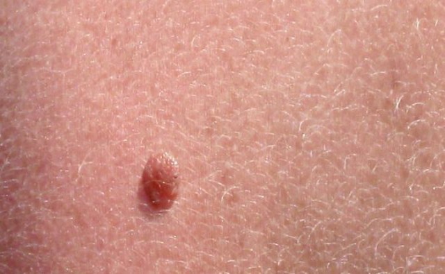 Ελιές στο δέρμα- Πώς θα καταλάβετε αν κάποια είναι καρκινική