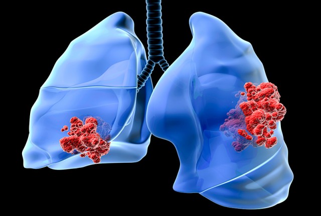 Καρκίνος του πνεύμονα: Αίτια, συμπτώματα και θεραπεία