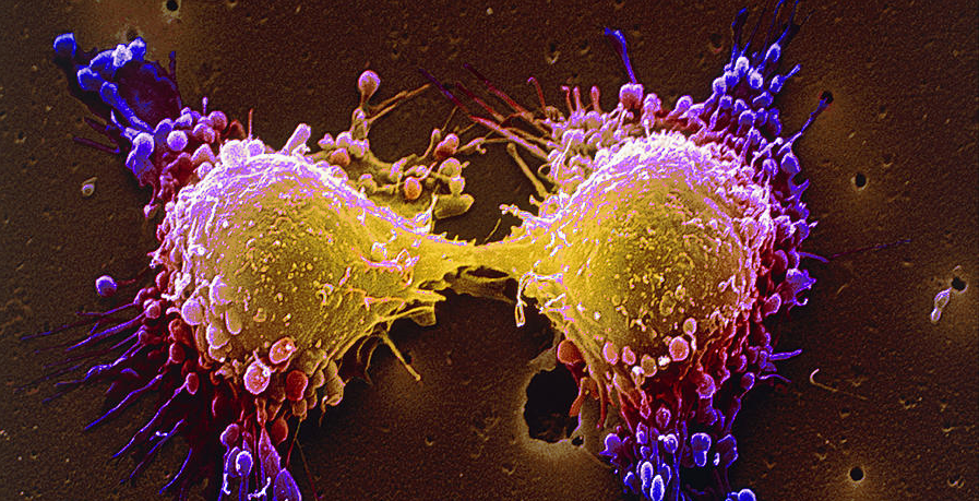 Ανακαλύφθηκε η «αχίλλειος πτέρνα» του καρκίνου