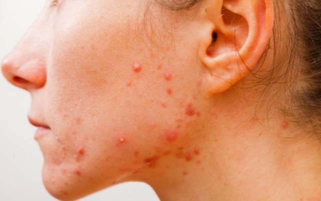 Ακμή- Οι καθημερινές συνήθειες που την πυροδοτούν