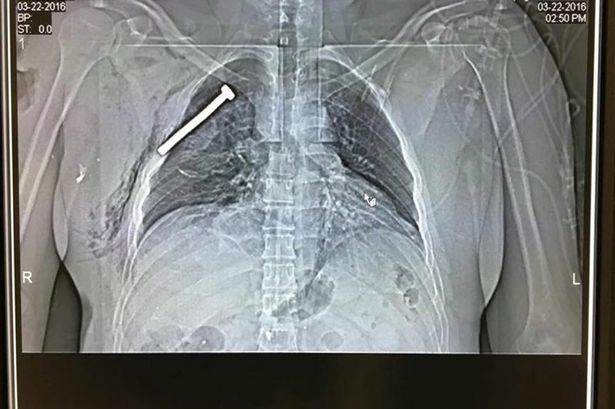 Σοκάρει η ακτινογραφία τραυματία από το μακελειό στις Βρυξέλλες