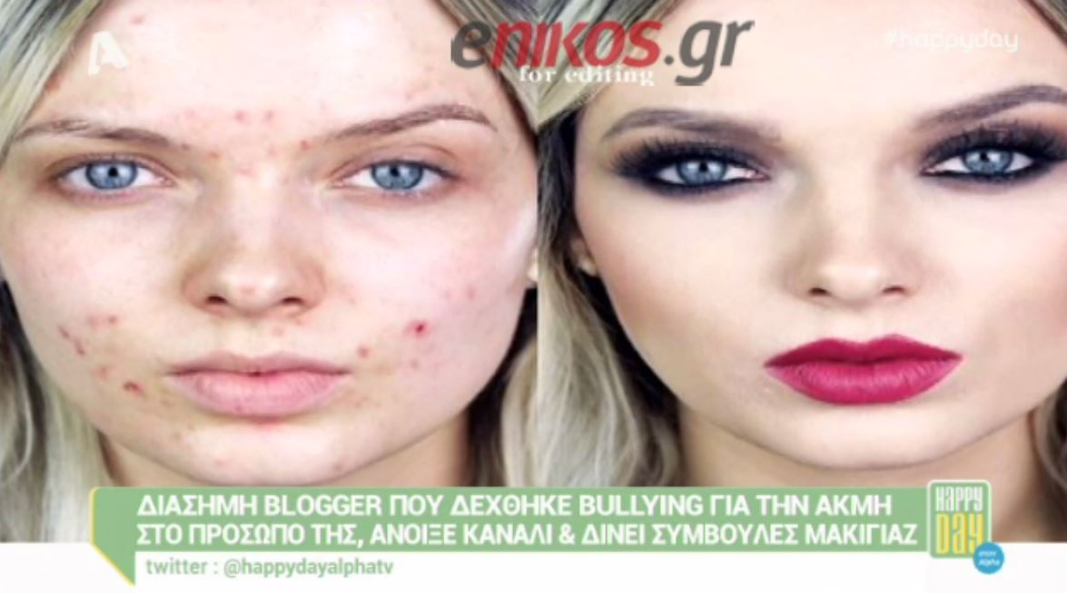 Υπέφερε από ακμή και βρήκε τρόπους να είναι όμορφη – ΒΙΝΤΕΟ