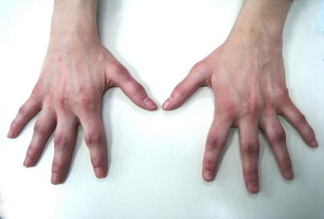 Γιατί τα αρθριτικά νοσήματα προσβάλλουν 1 στους 5 ενήλικες