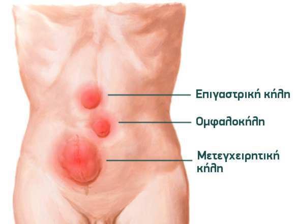 Λαπαροσκοπική αποκατάσταση κηλών