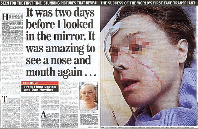 The Daily Mail had an exclusive interview with Miss Dinoir in December 2005 when she spoke of plucking up the courage to look in the mirror for the first time after surgery