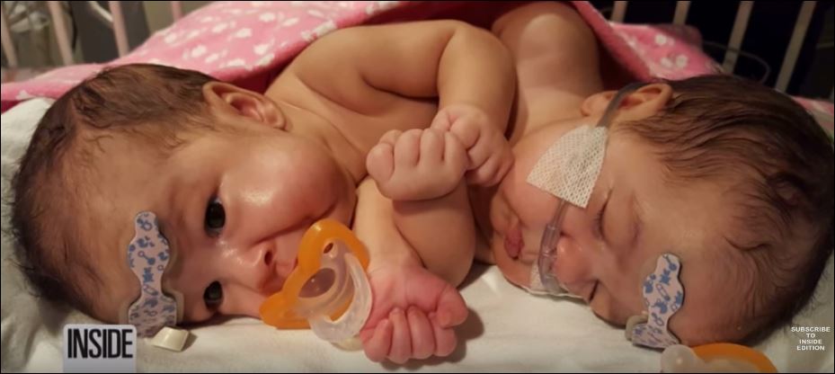 Σιαμαία μωρά επιβιώνουν μετά τον διαχωρισμό τους – ΒΙΝΤΕΟ