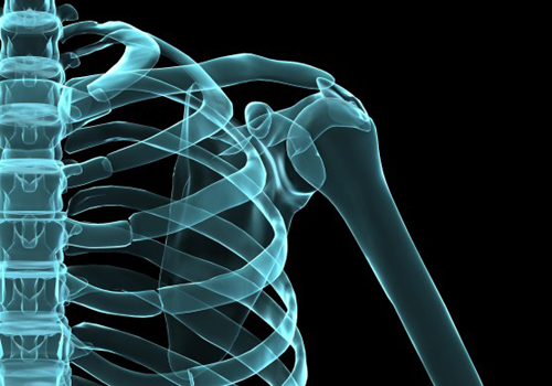 Συνθετικά οστά από 3D εκτυπωτή για τα κατάγματα