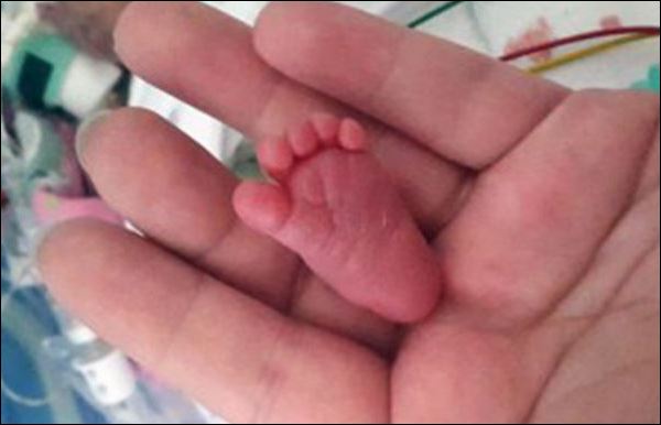 Το μικρότερο μωρό στον κόσμο – Ζυγίζει μόλις 227 γραμμάρια – ΦΩΤΟ