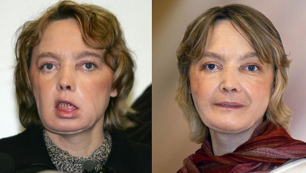 Πέθανε η Γαλλίδα που έκανε την πρώτη μεταμόσχευση προσώπου