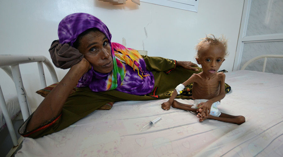 Σοκάρει η εικόνα ενός υποσιτισμένου παιδιού που δείχνει τη φρίκη του εμφυλίου στην Υεμένη – ΦΩΤΟ