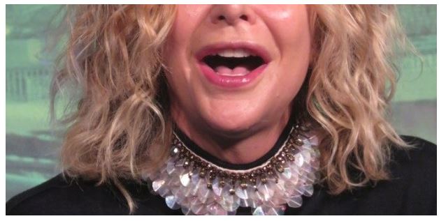 Παραμορφωμένη η διάσημη από τις αποτυχημένες πλαστικές