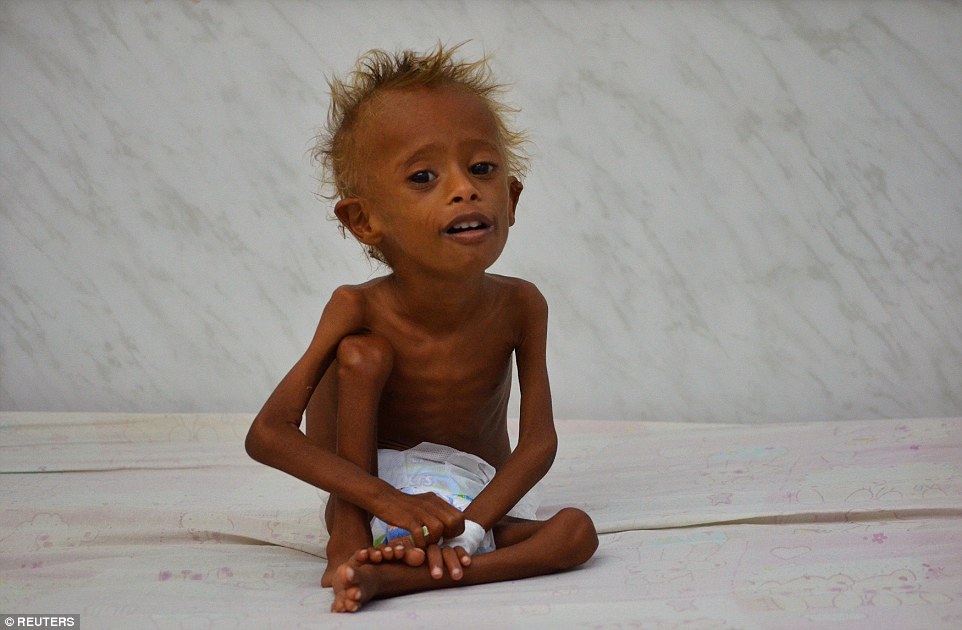 Σοκάρουν οι ΦΩΤΟ ενός υποσιτισμένου παιδιού στην Υεμένη