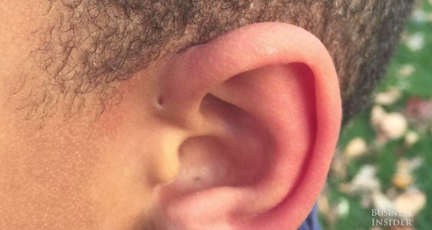 Γιατί κάποιοι άνθρωποι έχουν μια μικρή τρυπούλα πάνω στο αυτί τους; – ΒΙΝΤΕΟ