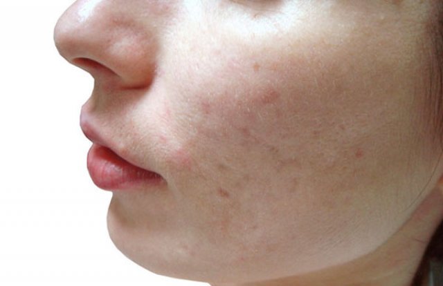 Ουλές ακμής: Πώς δημιουργούνται και πώς αντιμετωπίζονται