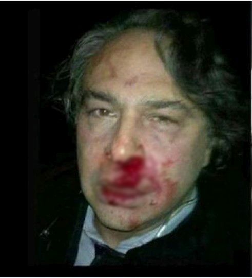 Νέες ΦΩΤΟ του Τούρκου σχεδιαστή μόδας μετά την επίθεση που δέχτηκε