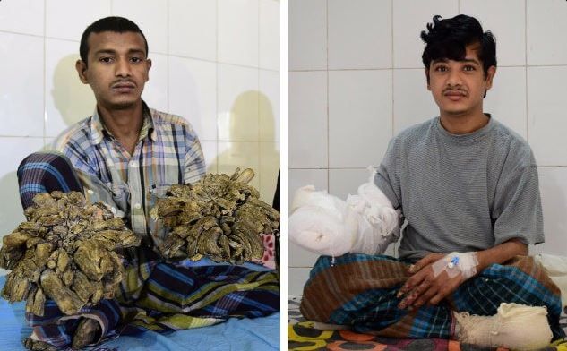 Οι γιατροί έδωσαν χέρια στον «άνθρωπο δέντρο» του Μπαγκλαντές – ΦΩΤΟ