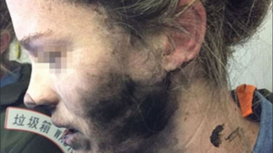 Εξερράγησαν τα ακουστικά της και υπέστη πολλαπλά εγκαύματα – ΦΩΤΟ