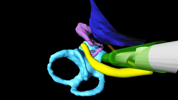 Έλληνας πίσω από την ανάπτυξη υψηλής ακρίβειας χειρουργικού ρομπότ