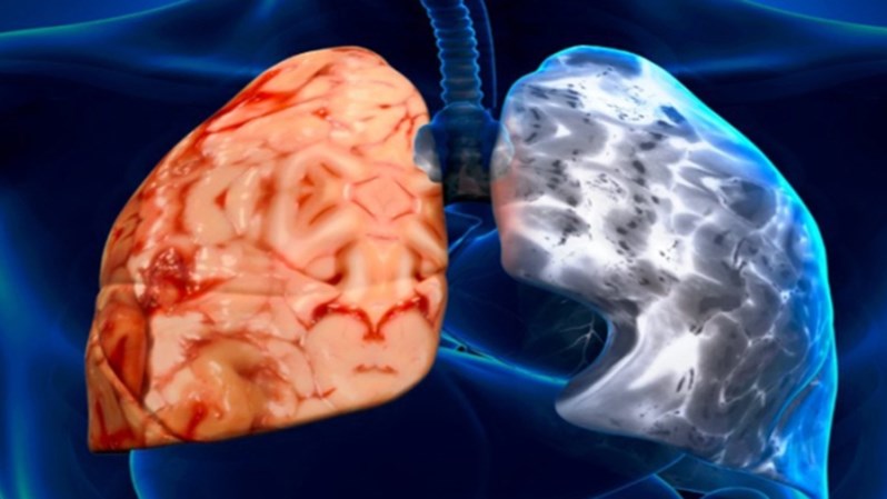 Ελληνίδα ερευνήτρια ρίχνει φως στο γενετικό υπόβαθρο της χρόνιας αποφρακτικής πνευμονοπάθειας