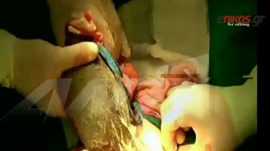 Γιατρός του Παίδων Πεντέλης έσωσε από το θάνατο μία 8χρονη που έτρωγε τα μαλλιά της – ΒΙΝΤΕΟ