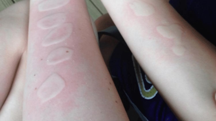 Salt and Ice Challenge: Νέο άκρως επικίνδυνο παιχνίδι του διαδικτύου