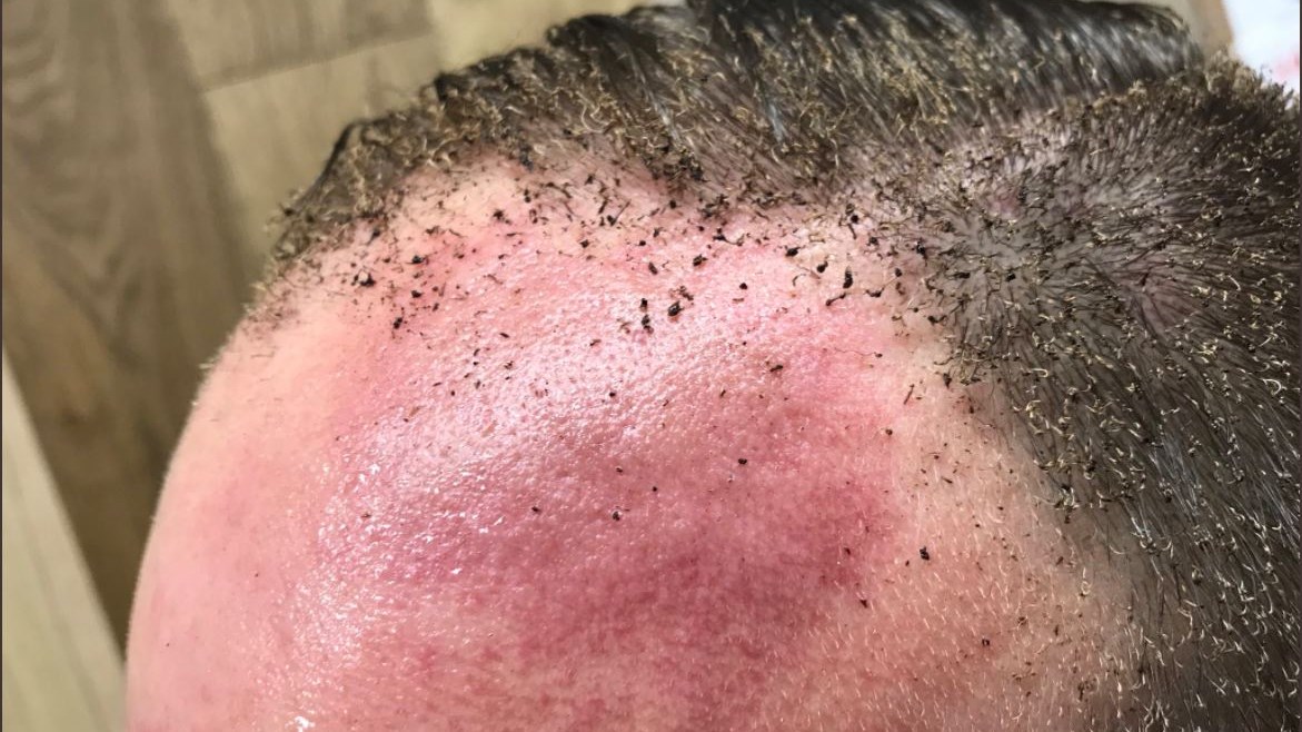 Σοκαριστικές εικόνες – Επιβάτης με εγκαύματα από την έκρηξη στο μετρό του Λονδίνου – ΦΩΤΟ