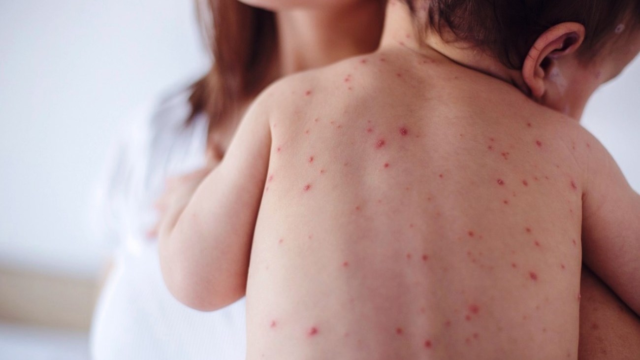 Βρέφος 11 μηνών το πρώτο θύμα της ιλαράς στην Ελλάδα