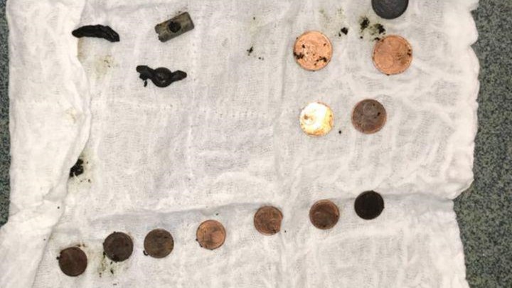 Γιατροί αφαίρεσαν περισσότερα από 100 μεταλλικά αντικείμενα από το στομάχι 52χρονου – ΦΩΤΟ