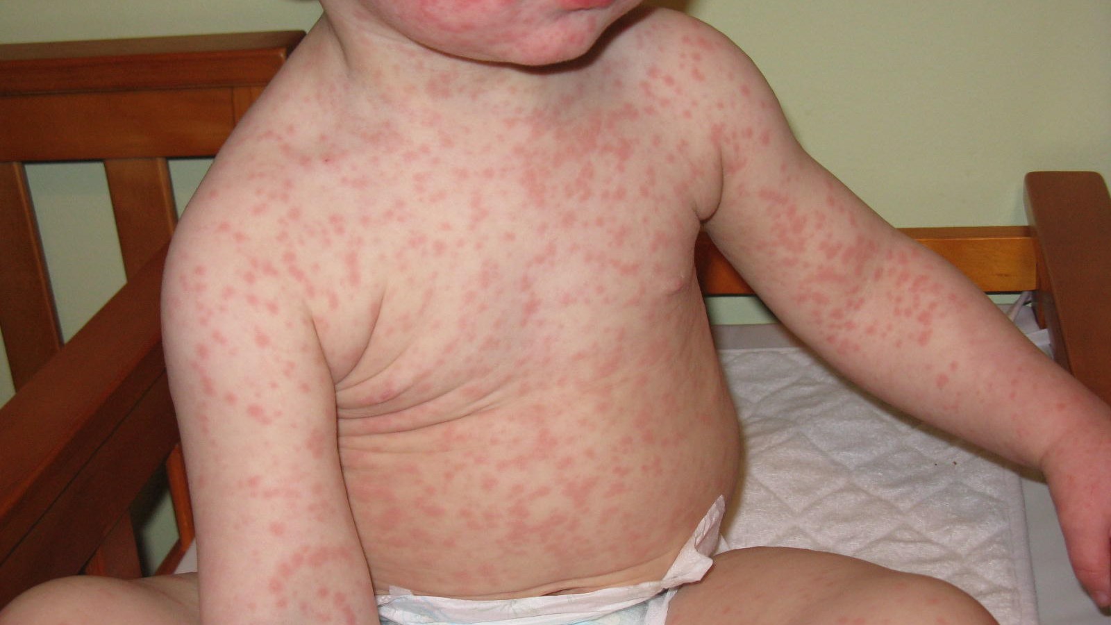 Συναγερμός με την ιλαρά – Αυξήθηκαν τα κρούσματα