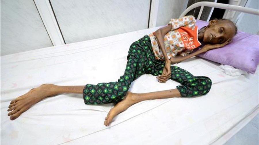 ΟΗΕ: Σοκαριστική η κατάσταση στην Υεμένη