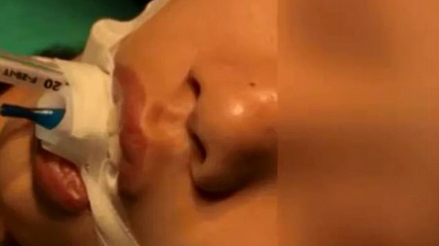 Σκληρές εικόνες – 10χρονη υπεβλήθη σε εγχείρηση ανοιχτού εγκεφάλου αφού η μάνα της, της πίεσε τα μαύρα στίγματα στη μύτη