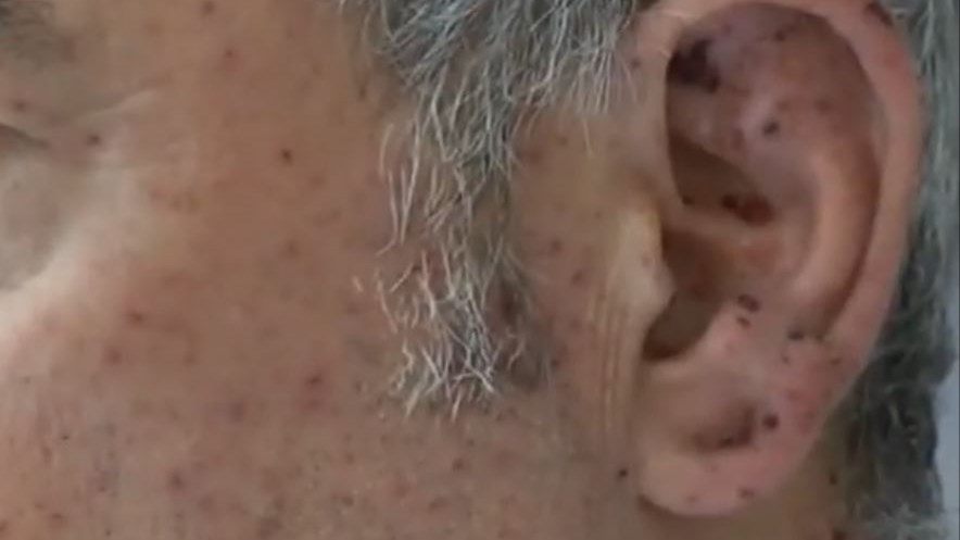 Ο ψυχίατρος που δέχθηκε μαφιόζικο “χτύπημα” στην Κρήτη δείχνει τα σημάδια του – ΒΙΝΤΕΟ