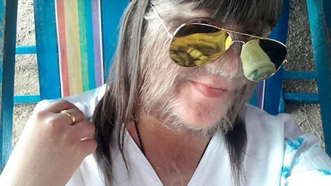 Το πιο τριχωτό κορίτσι στον κόσμο βρήκε τον έρωτα και … ξυρίστηκε – ΦΩΤΟ