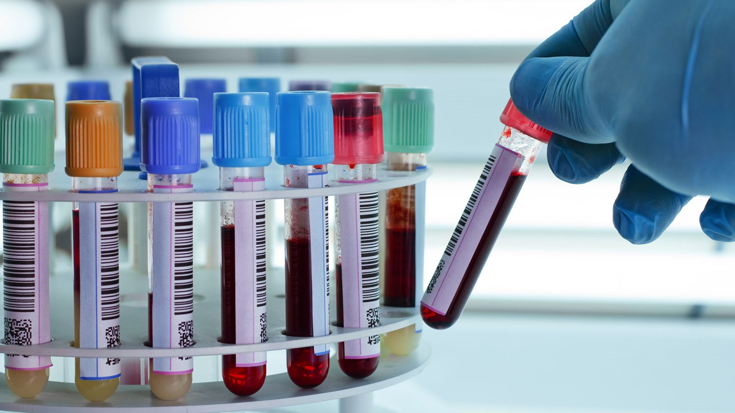 Σπουδαία ανακάλυψη Έλληνα επιστήμονα: Tεστ αίματος ανιχνεύει οκτώ είδη καρκίνου
