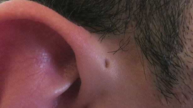Γιατί κάποιοι άνθρωποι έχουν μια μικρή τρυπούλα στο αυτί τους; – ΒΙΝΤΕΟ