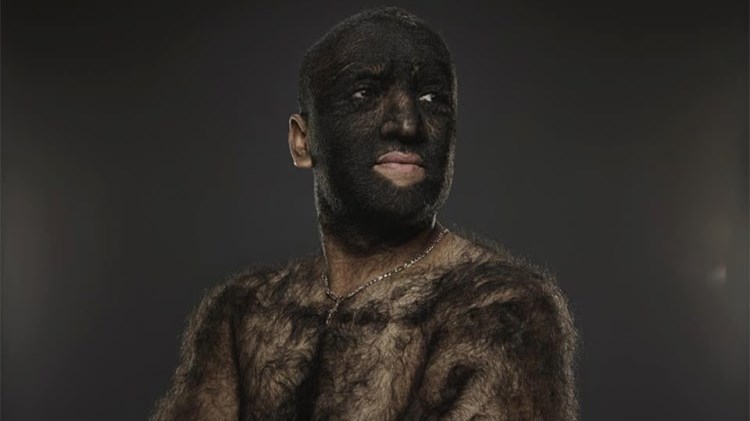 Ο πιο μαλλιαρός άνδρας στον κόσμο – Οι τρίχες καλύπτουν το 98% του σώματός του – ΒΙΝΤΕΟ