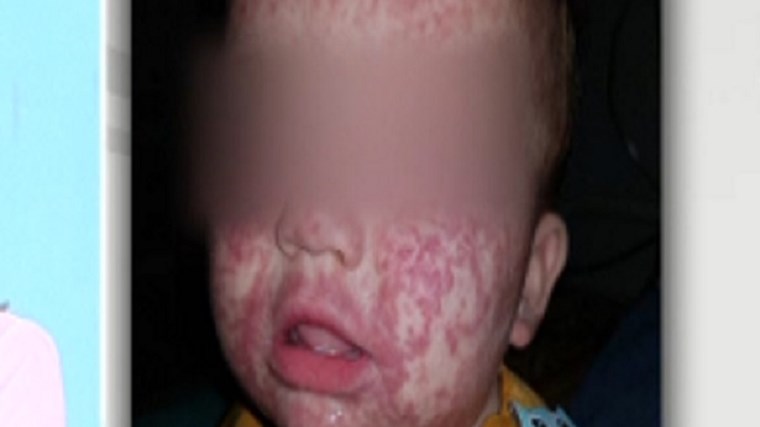 Γονείς καταγγέλλουν: Το παιδί μας μπήκε στο νοσοκομείο με ωτίτιδα και βγήκε με ιλαρά – ΒΙΝΤΕΟ