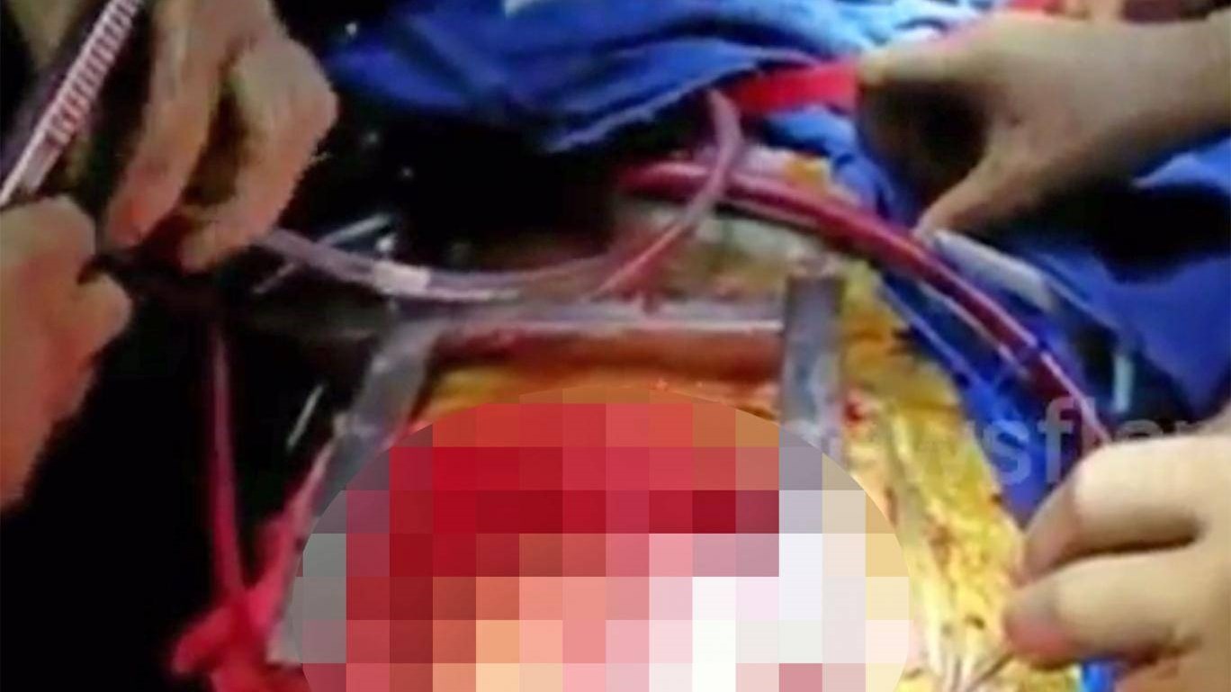 “Ξέμεινε” με δύο καρδιές όταν η μεταμόσχευση πήγε στραβά