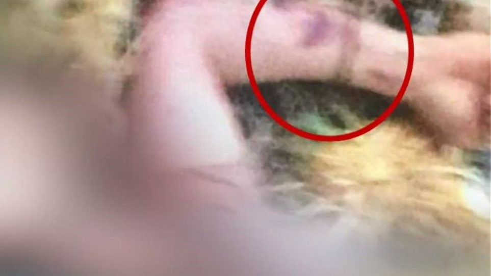 Φωτογραφία-ντοκουμέντο: Δείχνουν δολοφονία τα σημάδια στον καρπό του φοιτητή που βρέθηκε νεκρός στην Κάλυμνο;