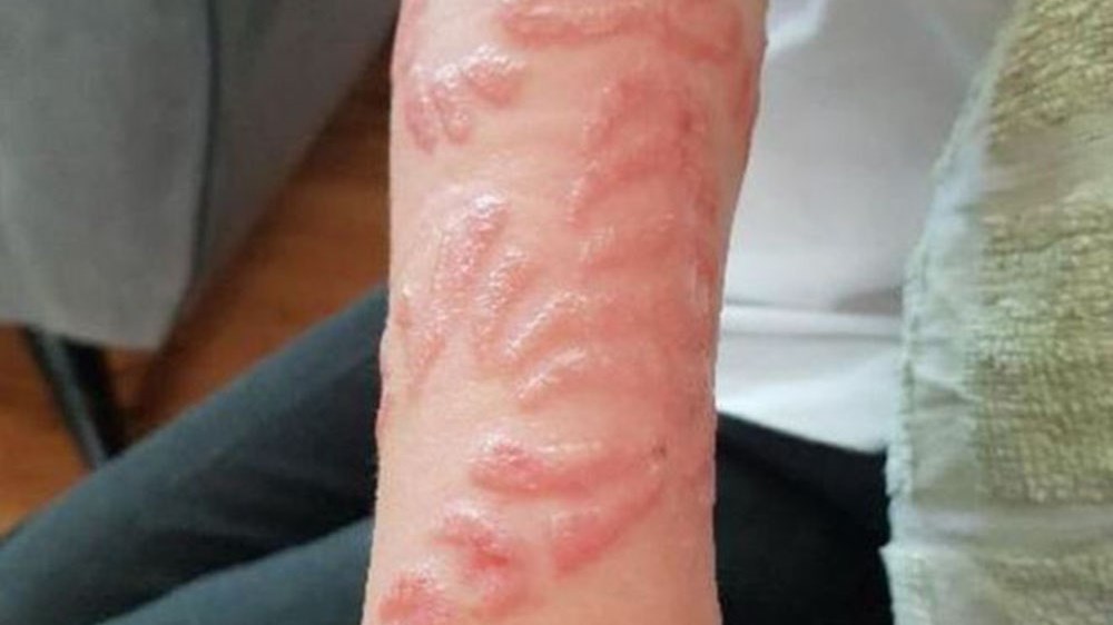 Σκληρές εικόνες – Έτσι κατέληξαν ένας 13χρονος και ένας 7χρονος που έκαναν τατουάζ henna – Tι λένε οι ειδικοί