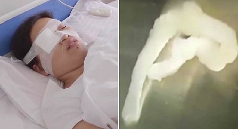 Βίντεο που σοκάρει – Έβγαλαν σκουλήκι από το μάτι γυναίκας – ΒΙΝΤΕΟ