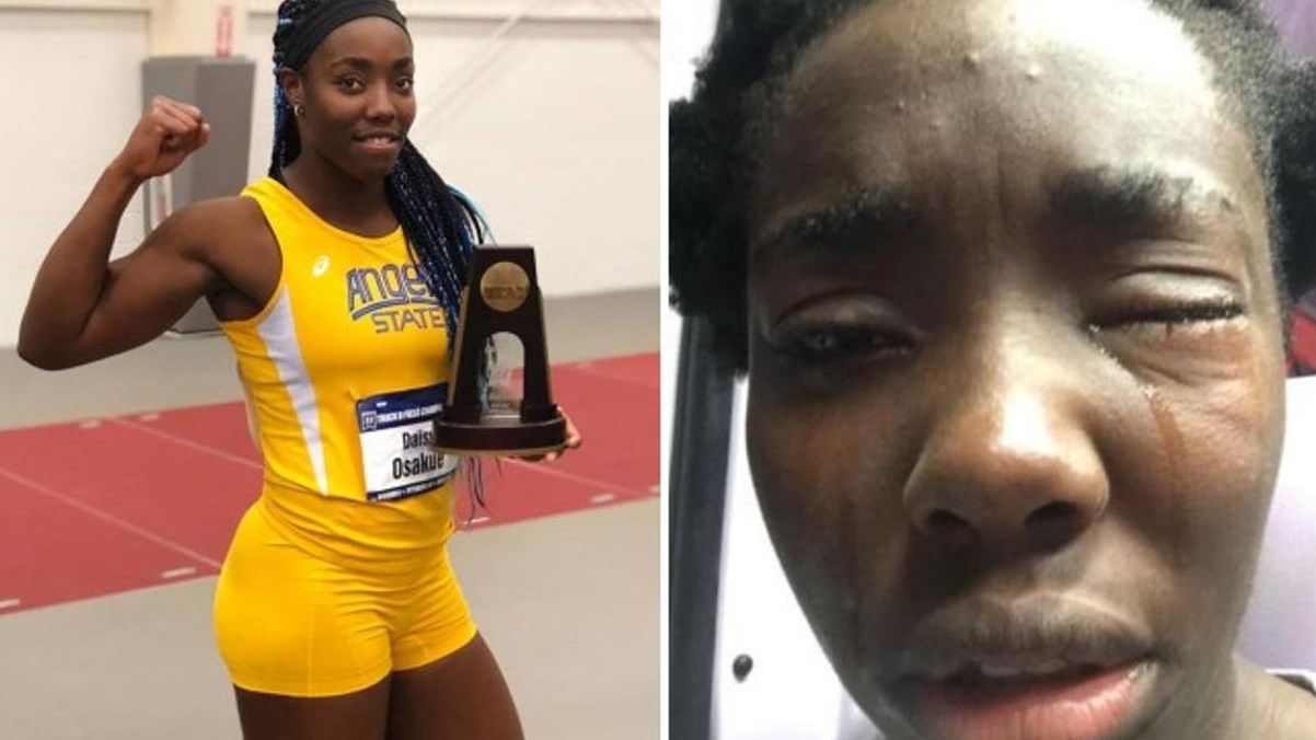 Ρατσιστική επίθεση σε βάρος αθλήτριας στην Ιταλία – Θα υποβληθεί σε επέμβαση – ΦΩΤΟ